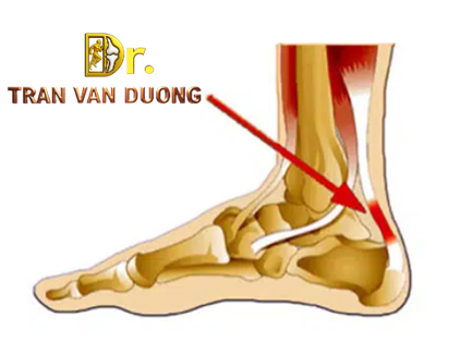 Hình minh họa vị trí Rách Và Đứt Gân Gót Chân Achilles - Bác sĩ Trần Văn Dương (TP.HCM)