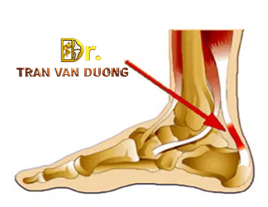 RÁCH VÀ ĐỨT GÂN GÓT CHÂN ACHILLES | BS Trần Văn Dương (TP.HCM)