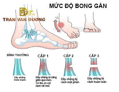 Các mức độ Bong gân mắt cá chân - Bác Sĩ Trần Văn Dương (TP. HCM)
