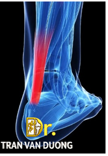 Hình minh họa đau gót chân do Rách Và Đứt Gân Gót Chân Achilles – Bác sĩ Trần Văn Dương (TP.HCM)