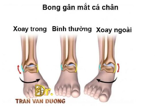 Hình minh họa các kiểu Bong Gân Mắt Cá Chân – Bác sĩ Trần Văn Dương (TP.HCM)
