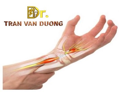 HỘI CHỨNG ỐNG CỔ TAY | BS Trần Văn Dương (TP.HCM)