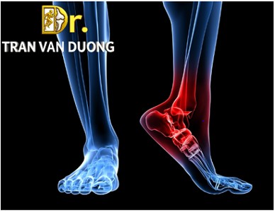 VIÊM CÂN GAN CHÂN | BS Trần Văn Dương (TP.HCM)