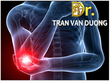Bác sĩ Trần Văn Dương (TP.HCM) – Chuyên khoa Cơ Xương Khớp điều trị Viêm Mỏm Lồi Cầu Ngoài Xương Cánh Tay