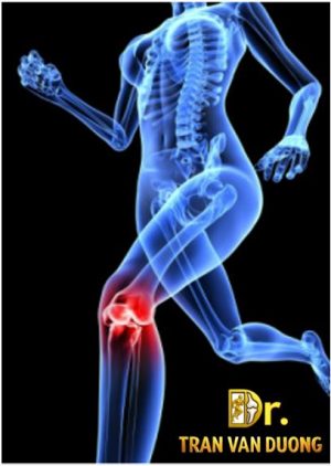 Hình minh họa vị trí đau vùng khớp gối trong Hội Chứng Đau Bánh Chè Đùi – Bác sĩ Trần Văn Dương (TP.HCM)