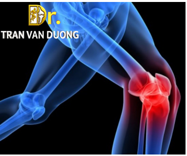 Hình minh họa vị trí đau đầu gối trong Viêm Khớp Gối – Bác sĩ CKII Trần Văn Dương (TP.HCM)