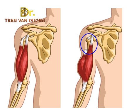 Hình minh họa Rách Gân Nhị Đầu Vai - Bác Sĩ Chuyên Khoa 2 Trần Văn Dương (TP.HCM)