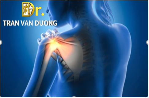 Hình minh họa đau vai gáy trong Rách Sụn Viền Khớp Vai - Bác sĩ Trần Văn Dương (TP. HCM)