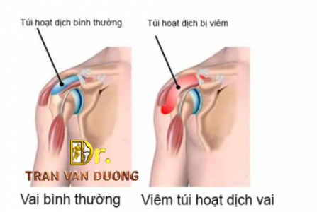 Nhận biết Viêm Bao Hoạt Dịch Khớp Vai – Bác sĩ CKII Trần Văn Dương (TP. HCM)