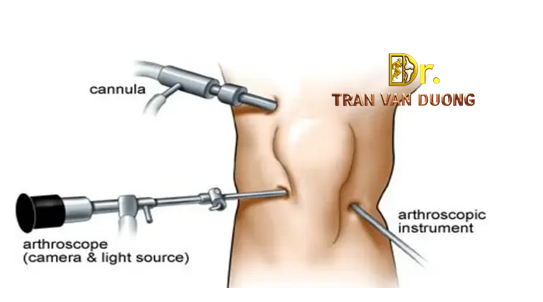 Hình minh họa phẫu thuật nội soi khớp gối để điều trị Đau Đầu Gối – Bác sĩ CK2 Trần Văn Dương (TP.HCM)
