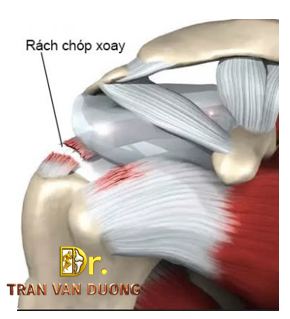 Hình minh họa đứt gân chóp xoay trong Rách Chóp Xoay - Bác sĩ CK2 Trần Văn Dương (TP. HCM)