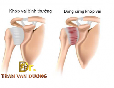 Khớp vai bình thường và đông cứng khớp vai - Bác sĩ CK2 Trần Văn Dương (TP.HCM)