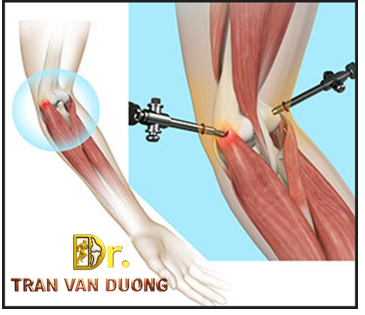 Phẫu thuật nội soi khớp vai điều trị Viêm Mỏm Lồi Cầu Ngoài Xương Cánh Tay – Bác sĩ CK2 Trần Văn Dương (TP.HCM)
