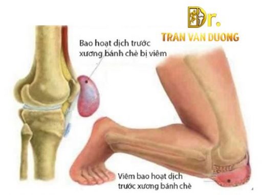 Viêm Bao Hoạt Dịch Trước Xương Bánh Chè do quỳ gối lâu – Bác sĩ Trần Văn Dương (TP.HCM)