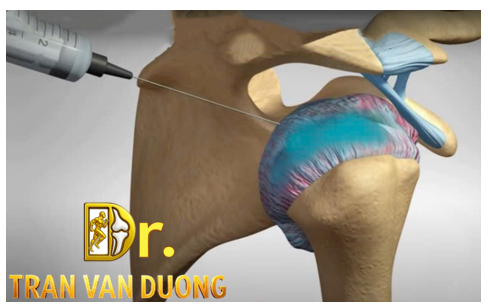 Tiêm kháng viêm và giảm đau điều trị Đông Cứng Khớp Vai - Bác sĩ CK2 Trần Văn Dương (TP.HCM)