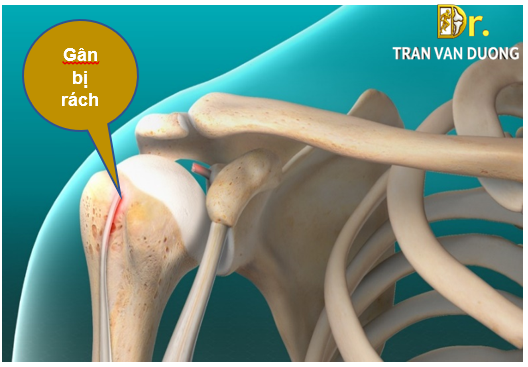 Hình minh họa gân nhị đầu bị rách trong Rách gân nhị đầu vai - BS Trần Văn Dương (TP. HCM)