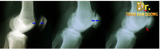 Tổn thương xương khớp trong Viêm Khớp Chè Đùi – Bác sĩ Trần Văn Dương (TP.HCM)