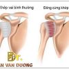 ĐÔNG CỨNG KHỚP VAI, HIỂU ĐÚNG ĐỂ ĐIỀU TRỊ ĐÚNG | BS Trần Văn Dương (TP.HCM)