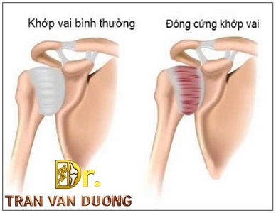 ĐÔNG CỨNG KHỚP VAI, HIỂU ĐÚNG ĐỂ ĐIỀU TRỊ ĐÚNG | BS Trần Văn Dương (TP.HCM)