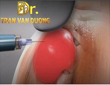 VIÊM BAO HOẠT DỊCH KHỚP VAI – BS Trần Văn Dương (TP.HCM)