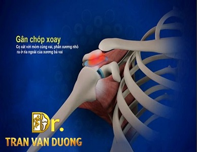 HỘI CHỨNG CHÈN ÉP VAI – BS Trần Văn Dương (TP. HCM)
