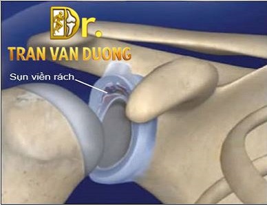 RÁCH SỤN VIỀN KHỚP VAI – BS Trần Văn Dương (TP.HCM)