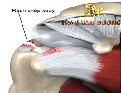 RÁCH CHÓP XOAY: NGUYÊN NHÂN, TRIỆU CHỨNG VÀ CÁCH ĐIỀU TRỊ | BS Trần Văn Dương (TP.HCM)