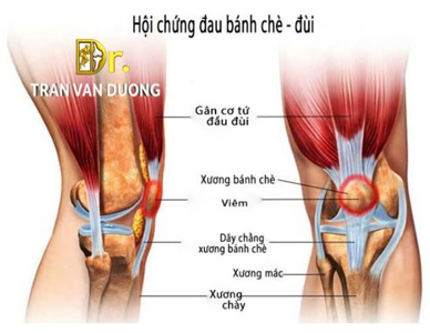 Hình minh họa vị trí bánh chè đùi – Bác sĩ Trần Văn Dương (TP.HCM)