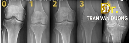 Các giai đoạn Viêm Khớp Gối - Bác sĩ CKII Trần Văn Dương (TP. HCM)