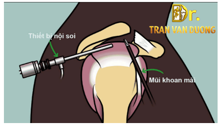 Phẫu thuật nội soi khớp vai điều trị Viêm Bao Hoạt Dịch Khớp Vai – Bác sĩ CK2 Trần Văn Dương (TP. HCM)