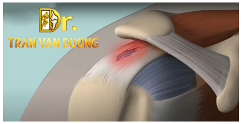 Hình minh họa mô tả chẩn đoán Rách Chóp Xoay - Bác sĩ CK2 Trần Văn Dương (TP.HCM)