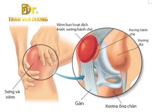 Đầu gối sưng và viêm trong Viêm Bao Hoạt Dịch Trước Xương Bánh Chè  – Bác sĩ Trần Văn Dương (TP.HCM)