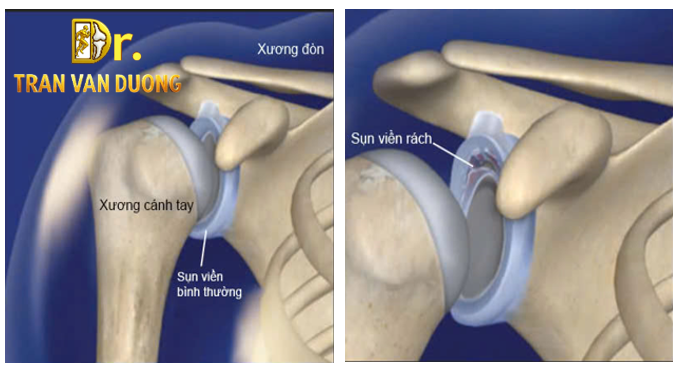 Phân biệt sụn viền khớp vai bình thường và rách sụn viền vai - Bác sĩ CK2 Trần Văn Dương (TP. HCM)