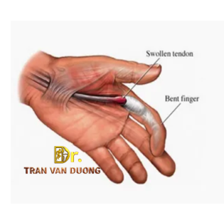 Hình minh họa triệu chứng Hội Chứng Ngón Tay Bật – Bác sĩ Trần Văn Dương (TP.HCM)