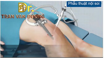 Phẫu thuật nội soi khớp gối để điều trị Viêm Khớp Chè Đùi – Bác sĩ Trần Văn Dương (TP.HCM)