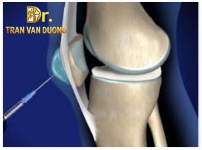 Chọc hút dịch và tiêm kháng viêm điều trị Viêm Bao Hoạt Dịch Trước Xương Bánh Chè – Bác sĩ Trần Văn Dương (TP.HCM)