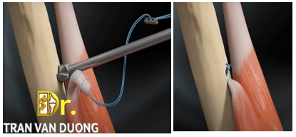 Phẫu thuật khâu gắn lại gân cho người bị Rách Gân Nhị Đầu Ở Vai - Bác sĩ CK2 Trần Văn Dương (TP. HCM)