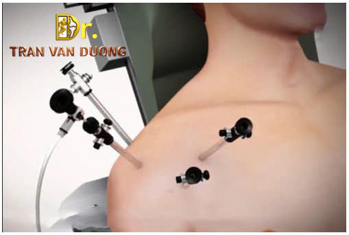 Hình minh họa phẫu thuật nội soi điều trị Rách Sụn Viền Vai - Bác sĩ Trần Văn Dương 