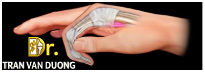 Đau do viêm bao gân gấp ngón tay trong ngón tay cò súng  – BS Trần Văn Dương (TP.HCM)