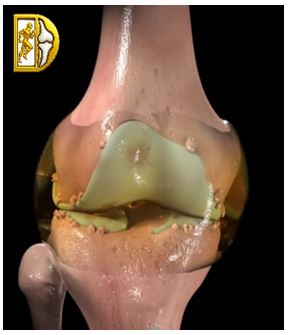 Hình minh họa Giai đoạn khớp gối thoái hóa trung bình – Bác sĩ Trần Văn Dương (TP.HCM)