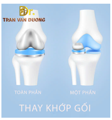 Phẫu thuật Thay khớp gối để điều trị Viêm Khớp Gối - Bác sĩ CKII Trần Văn Dương (TP.HCM)