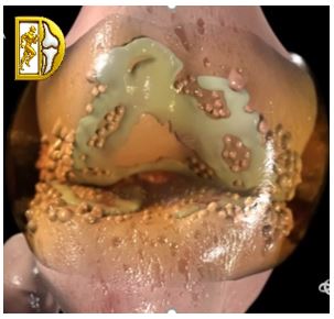 Hình minh họa Giai đoạn thoái hóa khớp gối nặng – Bác sĩ Trần Văn Dương (TP.HCM)