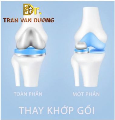 Hình minh họa thay khớp gối nhân tạo để điều trị Thoái Hóa Khớp Gối – Bác sĩ Trần Văn Dương (TP.HCM)