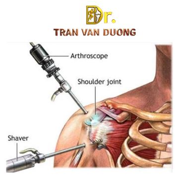 Hình minh họa phẫu thuật nội soi điều trị Rách Chóp Xoay - Bác sĩ CK2 Trần Văn Dương (TP.HCM) 