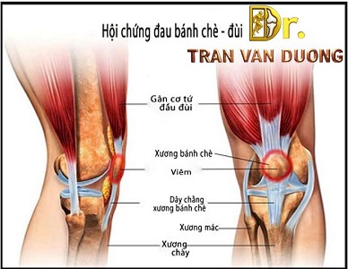 HỘI CHỨNG ĐAU BÁNH CHÈ ĐÙI – BS Trần Văn Dương (TP.HCM)