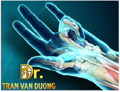 Hình minh họa Viêm bao gân gấp trong Hội Chứng Ngón Tay Bật – Bác sĩ CK2 Trần Văn Dương (TP. HCM)