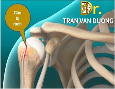 RÁCH GÂN NHỊ ĐẦU Ở VAI: HIỂU ĐÚNG ĐỂ ĐIỀU TRỊ HIỆU QUẢ