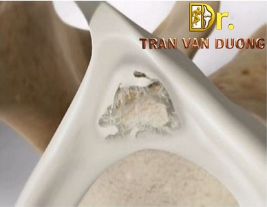 RÁCH SỤN VIỀN SLAP Ở KHỚP VAI