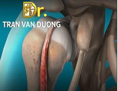VIÊM GÂN NHỊ ĐẦU CÁNH TAY – BS Trần Văn Dương (TP.HCM)