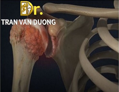 VIÊM KHỚP VAI – BS Trần Văn Dương (TP.HCM)
